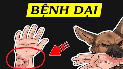 Bệnh dại