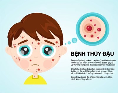 Cách phòng tránh bệnh thủy đậu