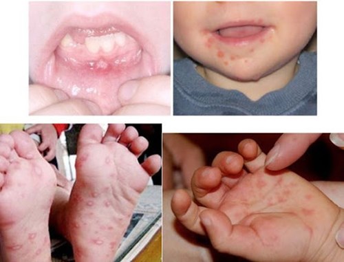 Về tuyên truyền, hướng dẫn phòng chống bệnh tay chân miệng