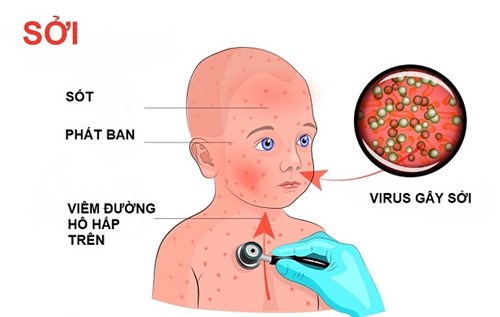 Thông tin tuyên truyền phòng tránh bệnh Sởi