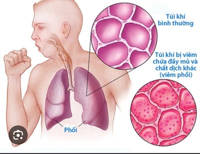 Bệnh viêm phổi nặng do Virus (SVP)